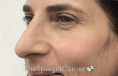 Revision Rhinoplasty Before & After Gallery - Patient 395251 - Image 1