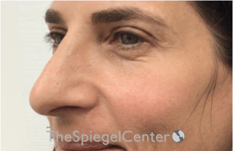 Rhinoplasty Before & After Gallery - Patient 785559 - Image 1