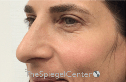 Rhinoplasty Before & After Gallery - Patient 785559 - Image 1