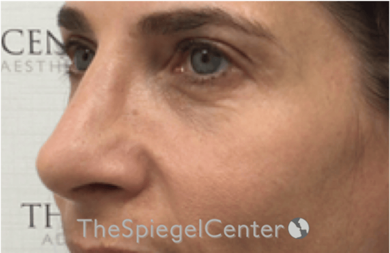 Rhinoplasty Before & After Gallery - Patient 785559 - Image 2