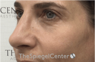 Revision Rhinoplasty Before & After Gallery - Patient 395251 - Image 2