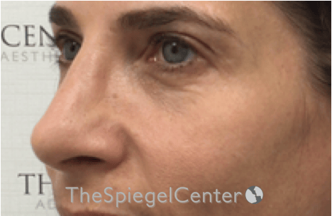 Rhinoplasty Before & After Gallery - Patient 785559 - Image 2