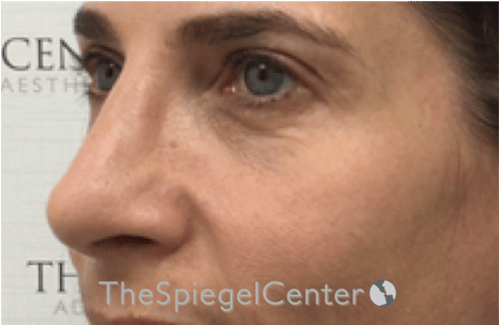 Rhinoplasty Before & After Gallery - Patient 785559 - Image 2