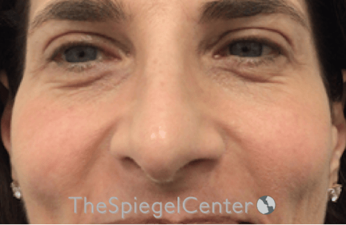 Rhinoplasty Before & After Gallery - Patient 785559 - Image 3