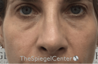 Rhinoplasty Before & After Gallery - Patient 785559 - Image 4