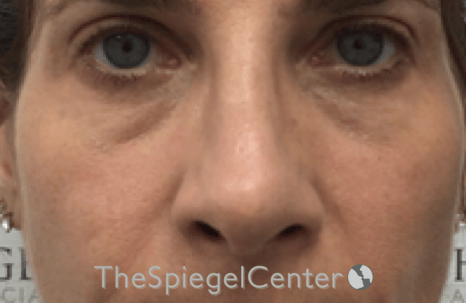 Rhinoplasty Before & After Gallery - Patient 785559 - Image 4