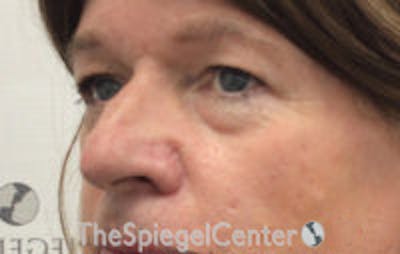 Rhinoplasty Before & After Gallery - Patient 216760 - Image 1