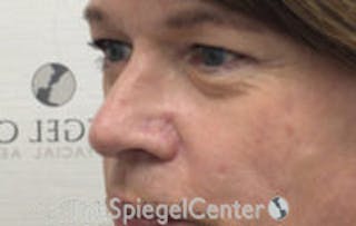 Rhinoplasty Before & After Gallery - Patient 216760 - Image 2