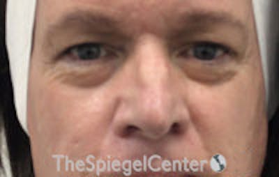 Rhinoplasty Before & After Gallery - Patient 216760 - Image 3