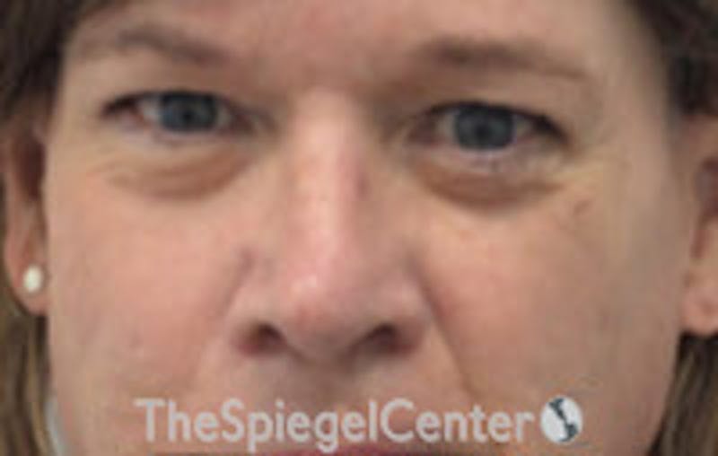 Rhinoplasty Before & After Gallery - Patient 216760 - Image 4