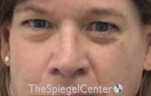 Rhinoplasty Before & After Gallery - Patient 216760 - Image 4