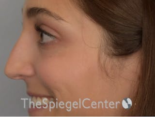 Rhinoplasty Before & After Gallery - Patient 250395 - Image 2