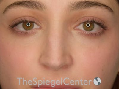 Rhinoplasty Before & After Gallery - Patient 250395 - Image 3