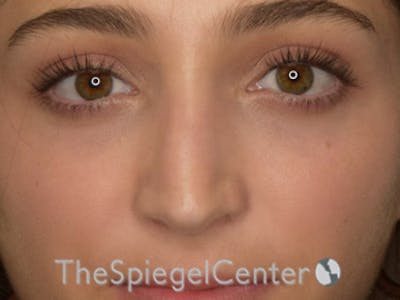 Rhinoplasty Before & After Gallery - Patient 250395 - Image 4