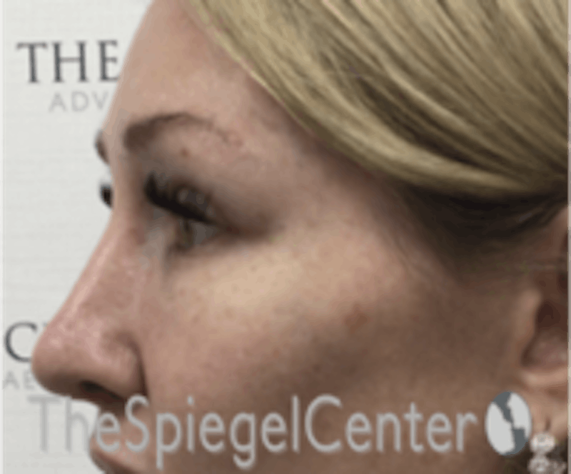 Rhinoplasty Before & After Gallery - Patient 648296 - Image 1