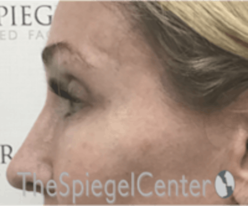 Rhinoplasty Before & After Gallery - Patient 648296 - Image 2