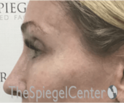 Rhinoplasty Before & After Gallery - Patient 648296 - Image 2