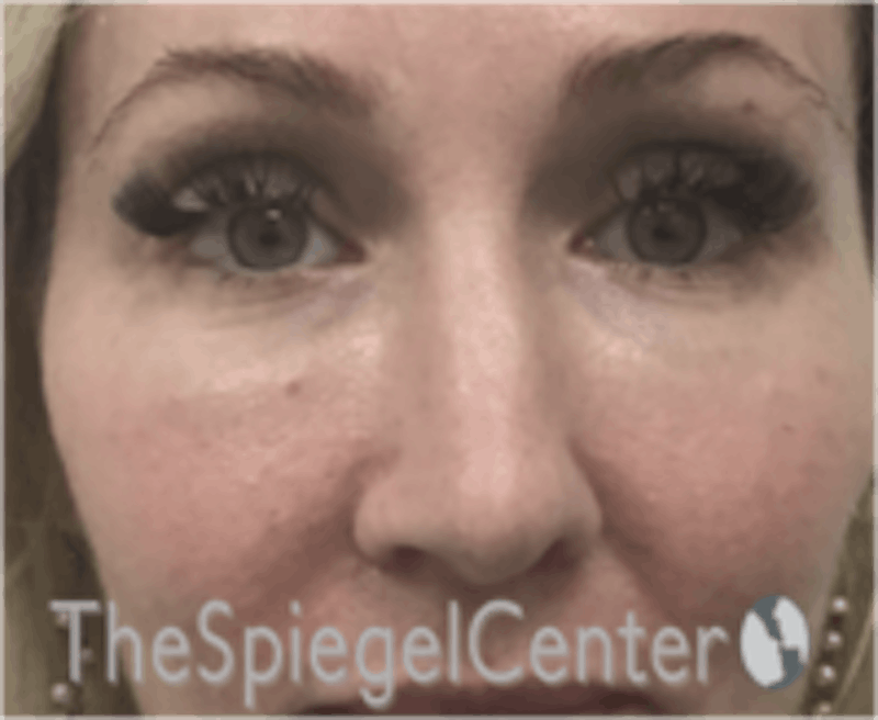 Rhinoplasty Before & After Gallery - Patient 648296 - Image 3