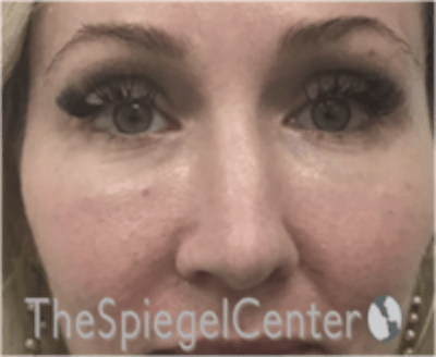 Rhinoplasty Before & After Gallery - Patient 648296 - Image 3