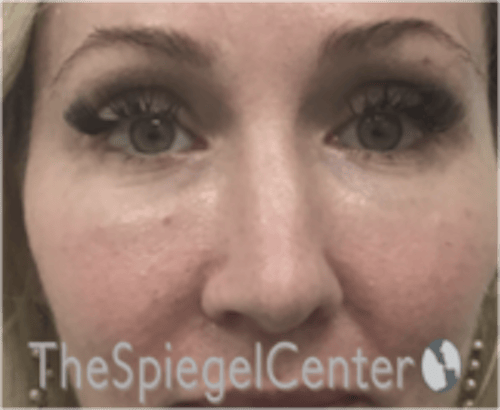 Rhinoplasty Before & After Gallery - Patient 648296 - Image 3