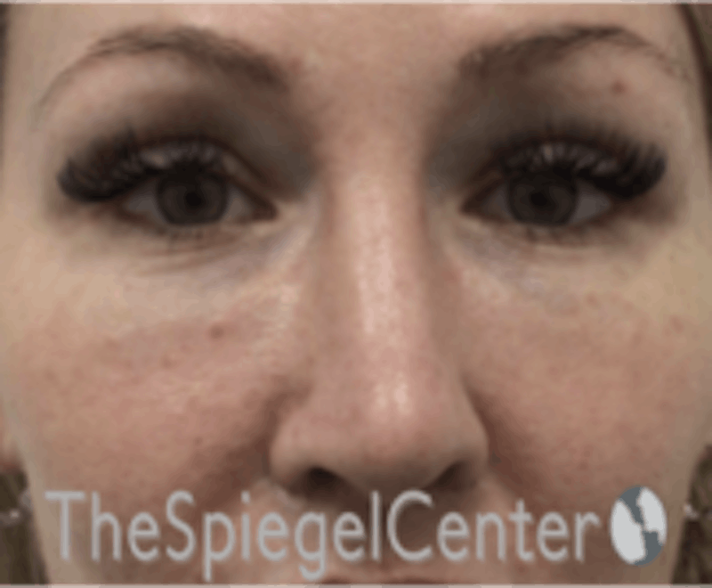 Rhinoplasty Before & After Gallery - Patient 648296 - Image 4
