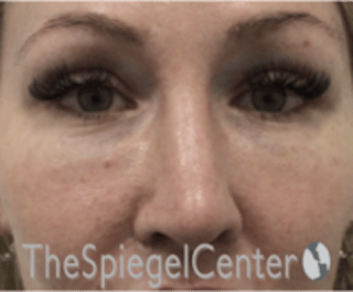 Rhinoplasty Before & After Gallery - Patient 648296 - Image 4