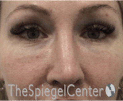 Rhinoplasty Before & After Gallery - Patient 648296 - Image 4
