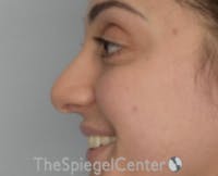 Rhinoplasty Before & After Gallery - Patient 234916 - Image 1