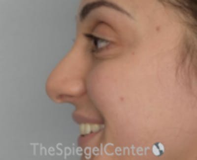 Rhinoplasty Before & After Gallery - Patient 234916 - Image 1