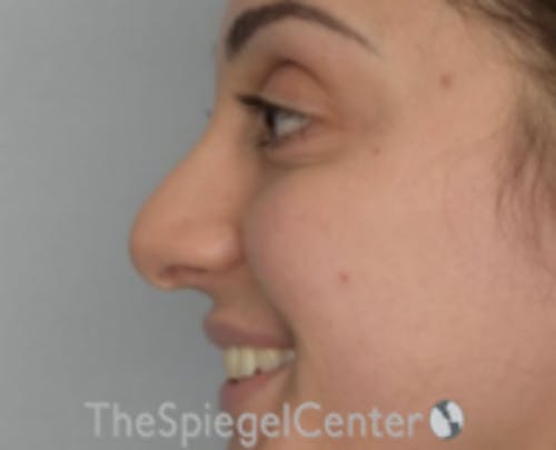 Rhinoplasty Before & After Gallery - Patient 234916 - Image 1