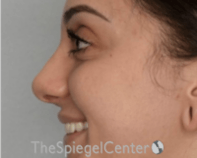 Rhinoplasty Before & After Gallery - Patient 234916 - Image 2