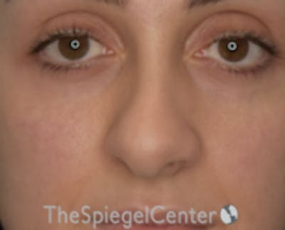 Rhinoplasty Before & After Gallery - Patient 234916 - Image 3