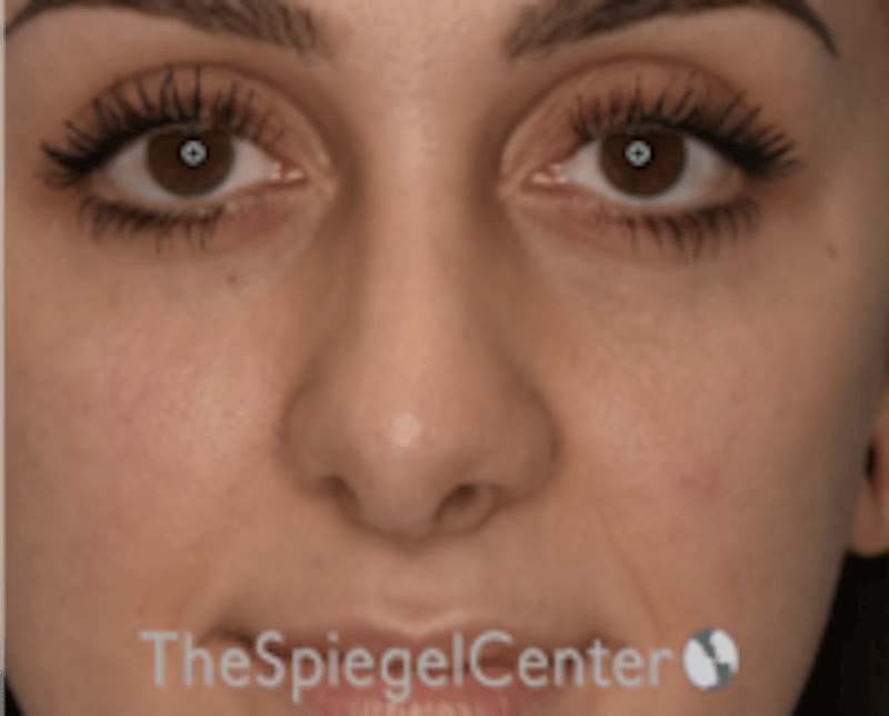 Rhinoplasty Before & After Gallery - Patient 234916 - Image 4