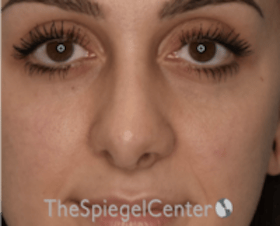 Rhinoplasty Before & After Gallery - Patient 234916 - Image 4