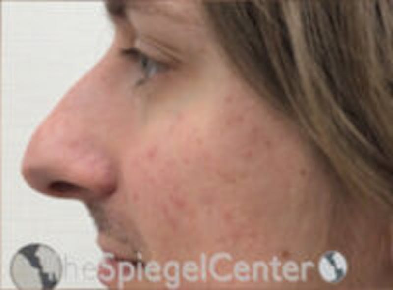 Rhinoplasty Before & After Gallery - Patient 627757 - Image 1