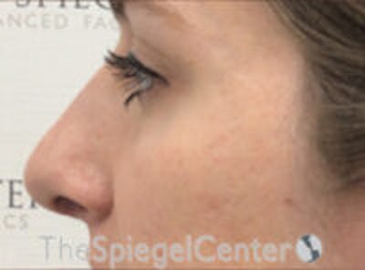 Rhinoplasty Before & After Gallery - Patient 627757 - Image 2