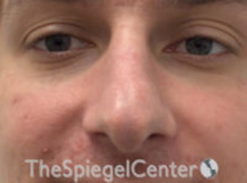 Rhinoplasty Before & After Gallery - Patient 627757 - Image 3