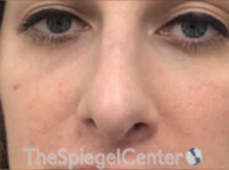 Rhinoplasty Before & After Gallery - Patient 627757 - Image 4