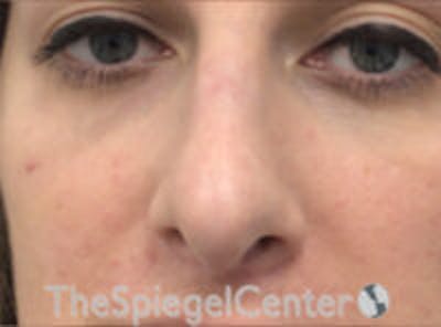 Rhinoplasty Before & After Gallery - Patient 627757 - Image 4
