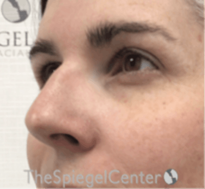 Rhinoplasty Before & After Gallery - Patient 134951 - Image 1