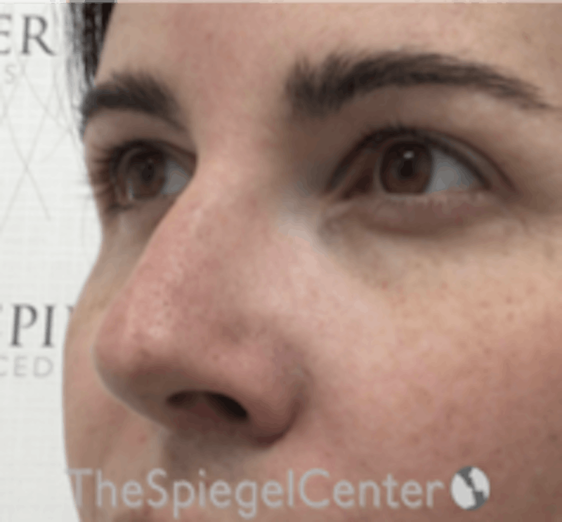 Rhinoplasty Before & After Gallery - Patient 134951 - Image 2