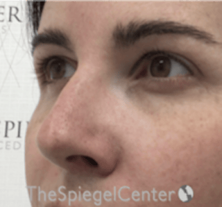 Rhinoplasty Before & After Gallery - Patient 134951 - Image 2