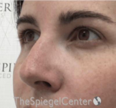 Rhinoplasty Before & After Gallery - Patient 134951 - Image 2