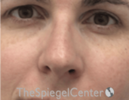 Rhinoplasty Before & After Gallery - Patient 134951 - Image 3