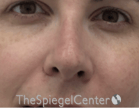 Rhinoplasty Before & After Gallery - Patient 134951 - Image 4