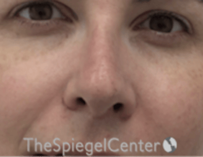 Rhinoplasty Before & After Gallery - Patient 134951 - Image 4