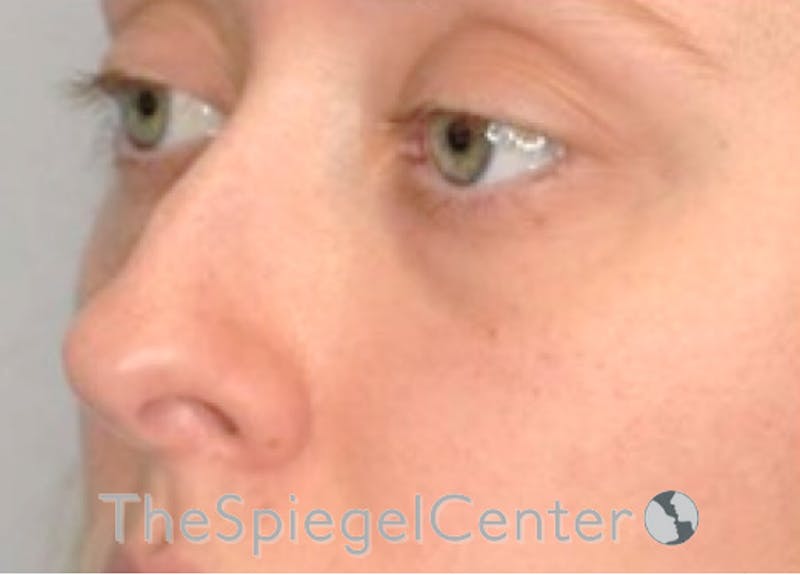 Rhinoplasty Before & After Gallery - Patient 132262 - Image 1