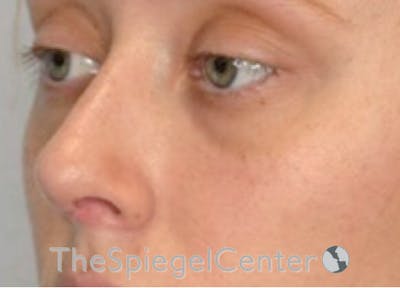 Rhinoplasty Before & After Gallery - Patient 132262 - Image 2