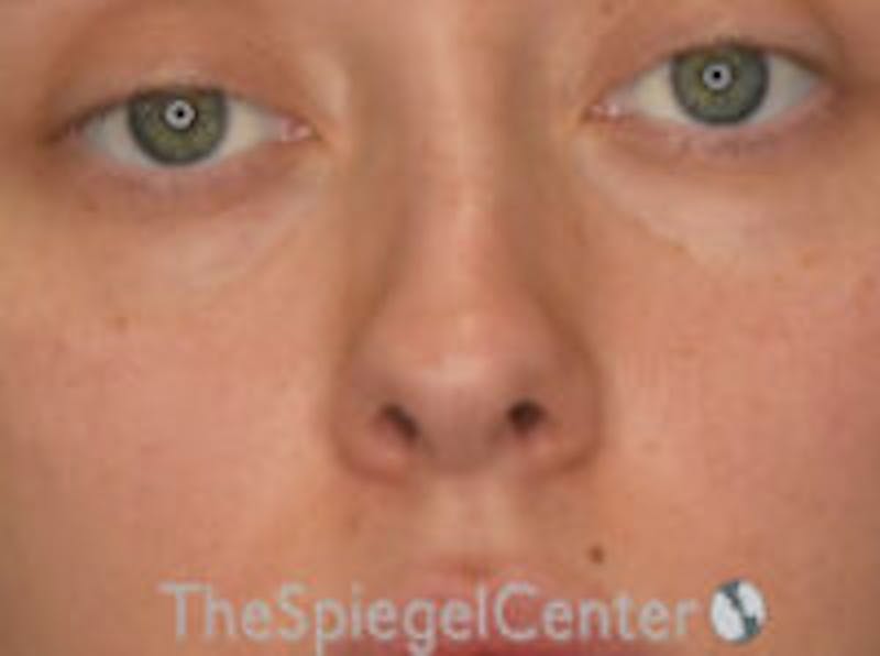 Rhinoplasty Before & After Gallery - Patient 132262 - Image 3