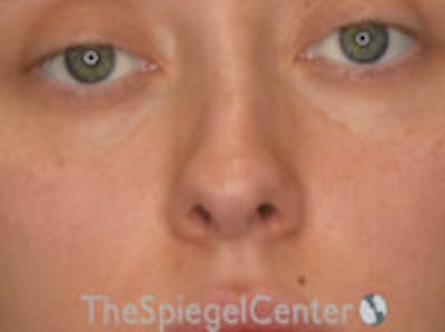 Rhinoplasty Before & After Gallery - Patient 132262 - Image 3